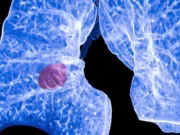 Inteligjenca artificiale zbulon tregues të rrezikut të kancerit në analizat e zakonshme të gjakut